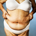 Бесшовная абдоминопластика