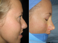 Ринопластика Собчак