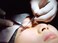 Этническая блефаропластика