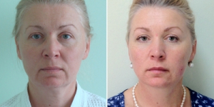 Пациентка Светланы Пшонкиной до и после