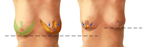 Особенности уменьшения груди