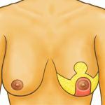 Уменьшение груди