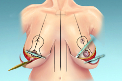 Классический метод уменьшения груди