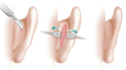 Отопластика