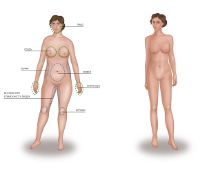 Липотрансфер