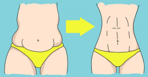 Абдоминопластика