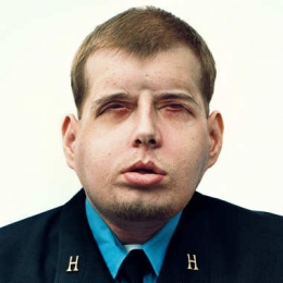 Патрик Хардисон после трансплантации лица Патрик Хардисон после трансплантации лица
