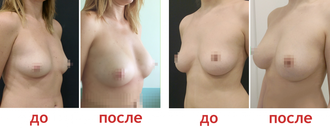 Фото до и после липофилинга груди в клинике Бьюти Тренд Фото до и после липофилинга груди в клинике Бьюти Тренд