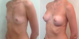 Ideal Breast Ideal Breast