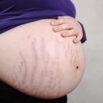 Хирургическая коррекция растяжек