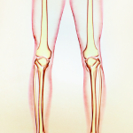 Хочу ровные ноги: как поможет эндопротезирование голеней