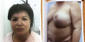 Ирина Внукова после операций Ирина Внукова после операций