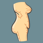 Ультразвуковая липосакция