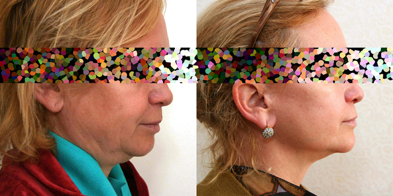 Пациентка пластического хирурга Александра Жукова до и после операции по подтяжке лица.