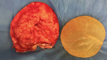 Удаление грудного импланта после капсульной контрактуры