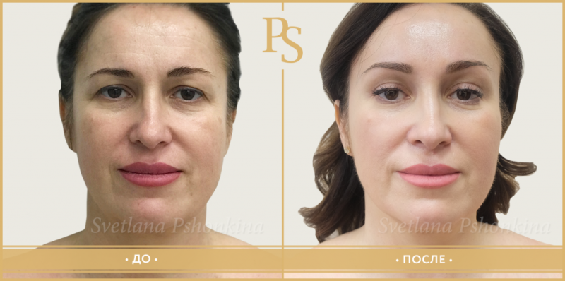 Пациентка доктора Светланы Пшонкиной до и после омоложения лица