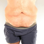 Торсопластика Светлана Пшонкина