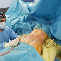 Пластический хирург Карен Пайтян и липомоделирование