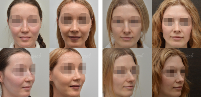 Пациентки доктора Стайсупова до и после коррекции носа