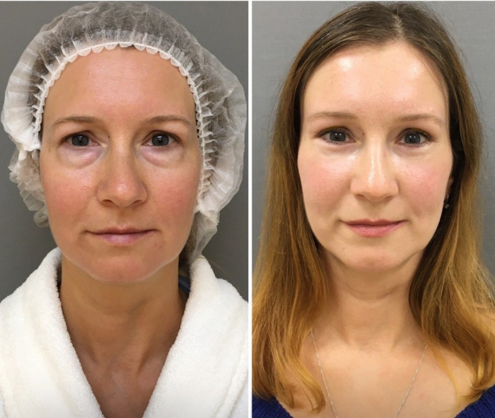 Пациентка доктора Марины Четвериковой до и после подтяжки лба и век