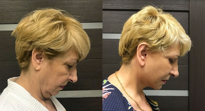 подтяжка лица Ольга Ованесова подтяжка лица Ольга Ованесова