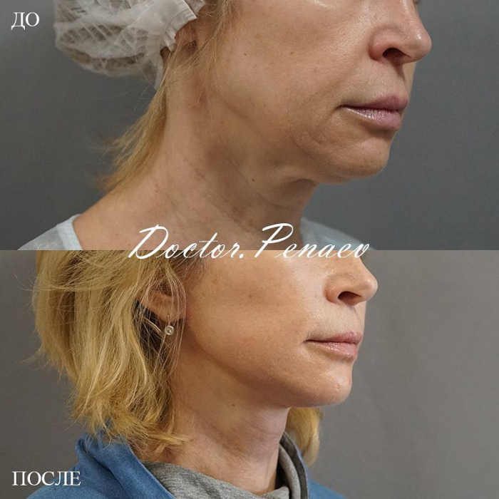 Пациентка доктора Арслана Пенаева до и после омоложения лица и шеи