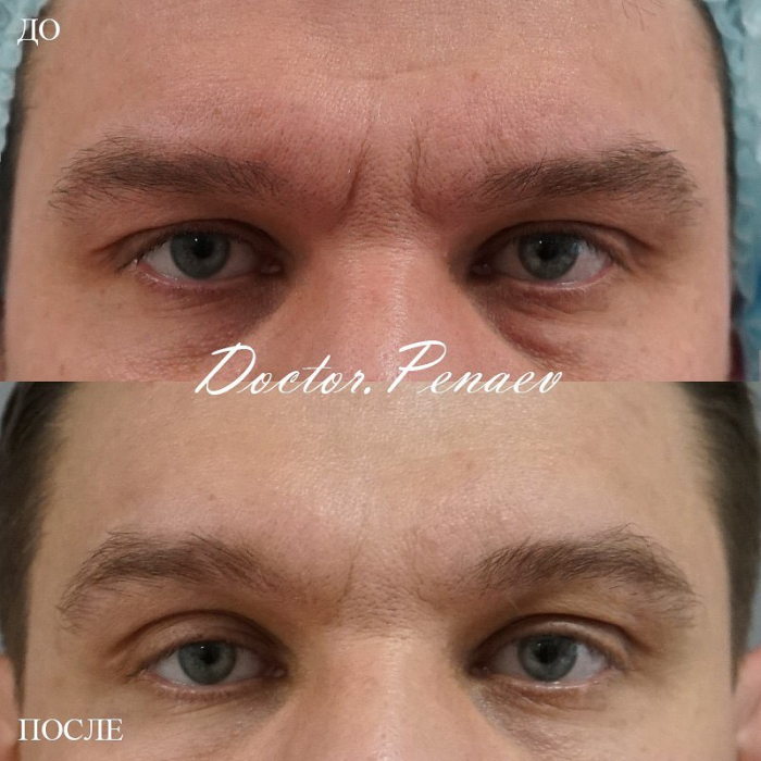 Пациент доктора Пенаева до и после процедуры «Вечный Ботокс»