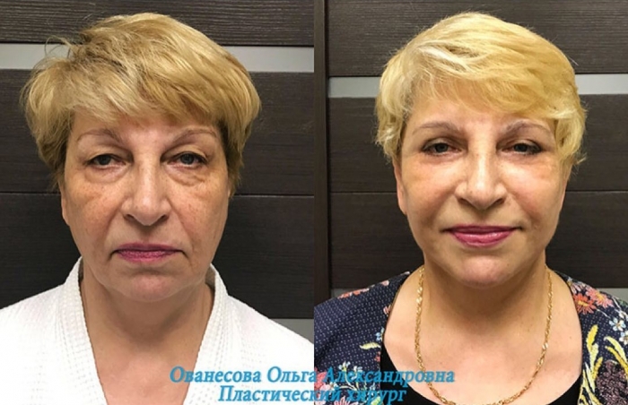 Пациентка до и после омоложения у доктора Ольги Ованесовой Пациентка до и после омоложения у доктора Ольги Ованесовой