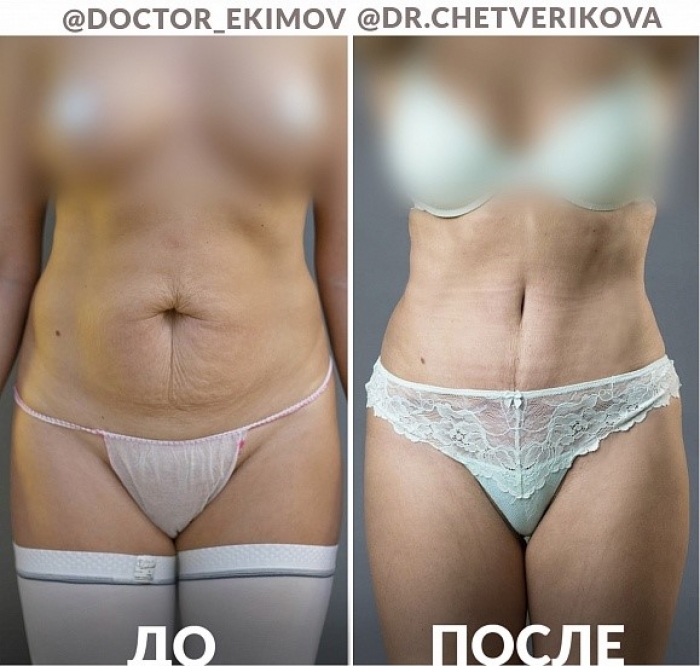 Пациентка до и после пластики живота у доктора Станислава Екимова и доктора Марины Четвериковой Пациентка до и после пластики живота у доктора Станислава Екимова и доктора Марины Четвериковой