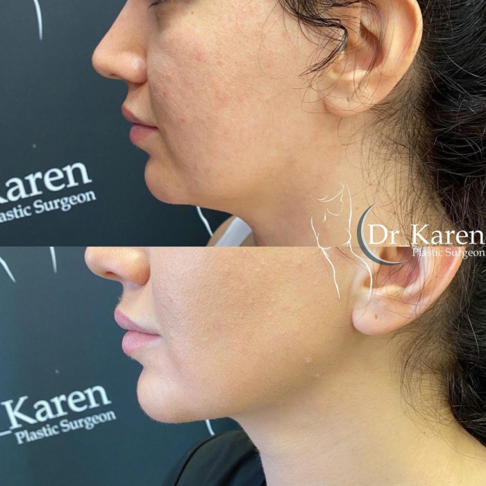Пациентка пластического хирурга Карена Пайтяна на фото до и после липосакции подбородка