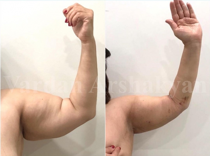 Пациентка доктора Аршакяна до и после радиочастотной подтяжки рук BrakhioTite Пациентка доктора Аршакяна до и после радиочастотной подтяжки рук BrakhioTite