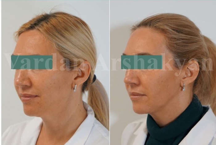 Пациентка доктора Аршакяна после скульптурирования лица FaceTite Пациентка доктора Аршакяна после скульптурирования лица FaceTite