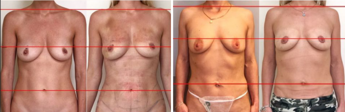 Фото пациенток после подтяжки груди BreastTite у доктора Вардана Аршакяна Фото пациенток после подтяжки груди BreastTite у доктора Вардана Аршакяна