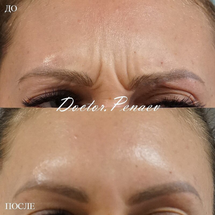Пациентка доктора Пенаева до и после процедуры «Вечный Ботокс»