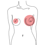 Асимметрия после увеличения груди: причины и решения
