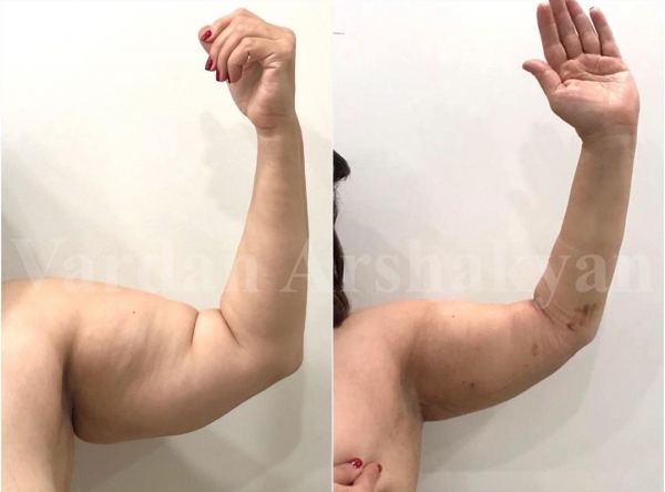 Пациентка доктора Аршакяна до и после пластики плеч BrakhioTite Пациентка доктора Аршакяна до и после пластики плеч BrakhioTite
