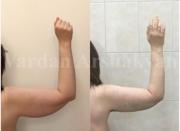 Пациентка доктора Аршакяна до и после радиочастотной пластики плеч BrakhioTite Пациентка доктора Аршакяна до и после радиочастотной пластики плеч BrakhioTite