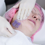 Омоложение лица после нитевых лифтингов