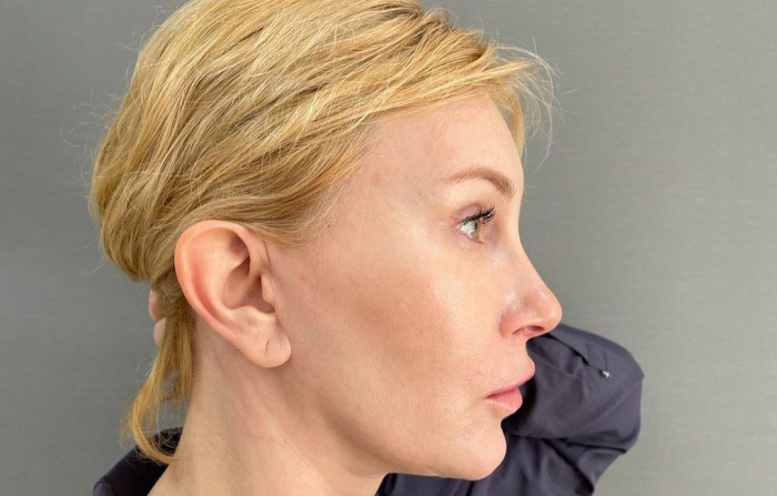 Шов осле смас-лифтинга за ухом