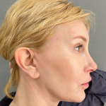 СМАС-лифтинг нижней трети