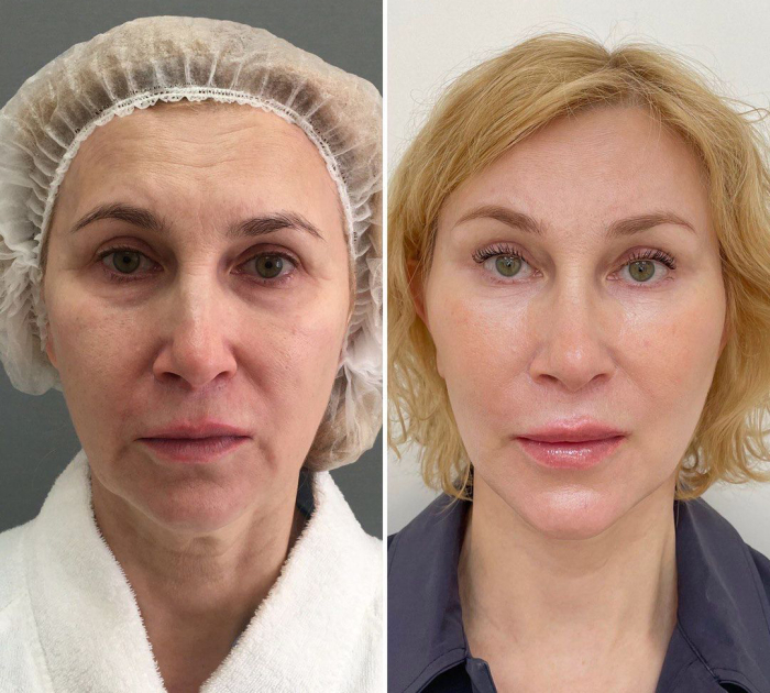 СМАС-лифтинг нижней трети лица и шеи и передняя платизмопластика