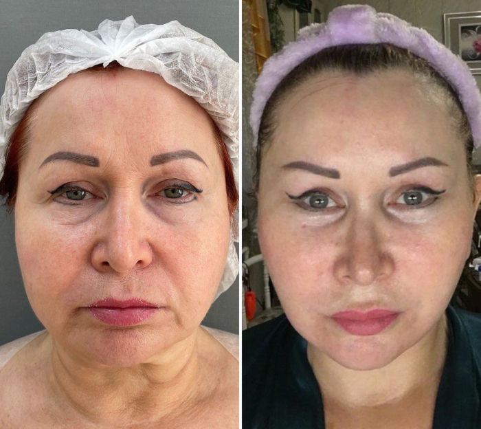 СМАС-лифтинг нижней трети и передняя платизмопластика