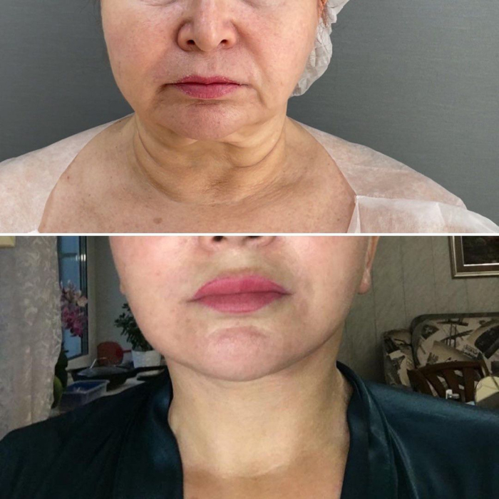 Передняя платизмопластика фото