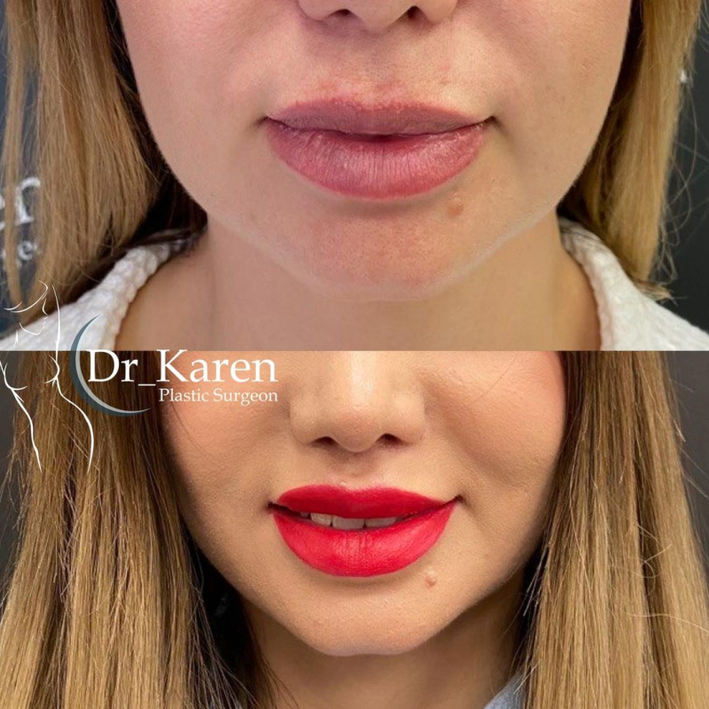 Пациентка хирурга Карена Пайтяна до и после булхорна губ