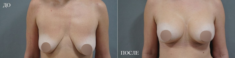 Пациентка доктора Пенаева до и после увеличения груди