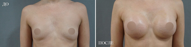 Пациентка доктора Пенаева до и после увеличения груди