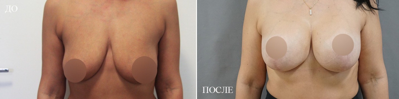 Пациентка доктора Пенаева до и после увеличения  и подтяжки груди