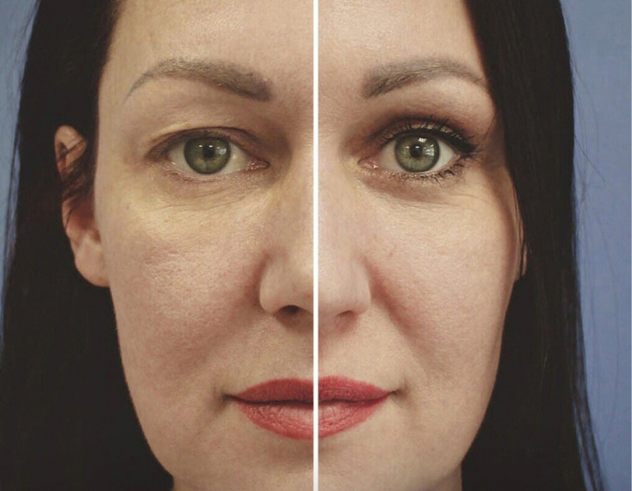 Верхняя блефаропластика Станислав Екимов