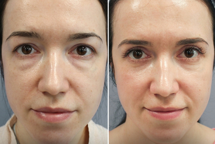 До и после блефаропластики