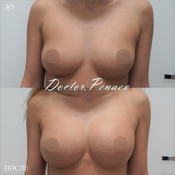 Пациентка профессора Пенаева до и после липотрансфера груди